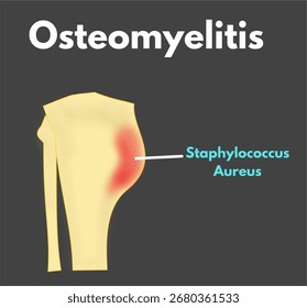 Osteomielitis ósea infectada Infección por estafilococo aureus de la enfermedad de la órbita ósea Inflamación