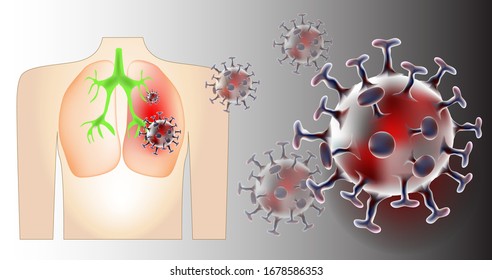 Infected lungs, viruses, pathogens placed on gray background, medical concept 