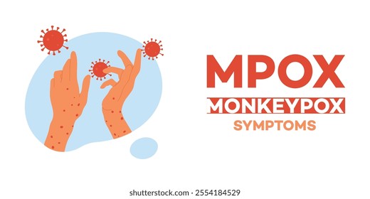 Infected person hands with monkeypox symptoms. Monkeypox prevention. Diseases, viruses and disorders Icons and Graphics. Hair and Skin, Emotion, Biology, Symptom, Infographic, Rash, Infection.