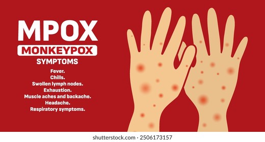 Infected person's hands with Mpox monkeypox virus. Illustration of visible rash and red lesions symptoms of the Monkeypox virus.