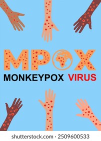 Infected person's hands with Mpox monkeypox virus. Illustration of visible rash and red lesions symptoms of the Monkeypox virus.