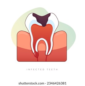 Infected Teeth - Root Canal Treatment - Stock Illustration as EPS 10 File