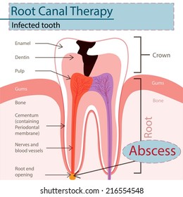 Infected tooth.