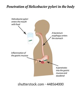 Infection with Helicobacter pylori. Infographics. Vector illustration on isolated background.