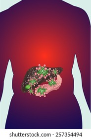 Infection with hepatitis viruses.