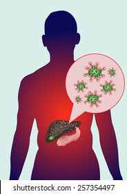 Infection with hepatitis viruses.