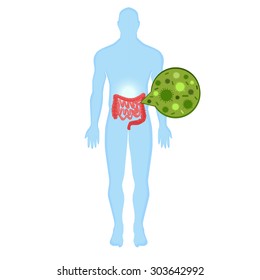 infection in the intestine illustration. blue Human silhouette, human intestines on a white background. Modern Medical vector infographics. Bowel disease, colon, small intestine, colon