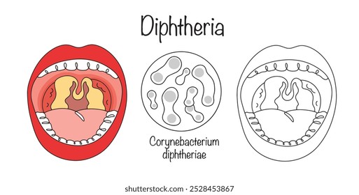 Uma doença infecciosa causada pela bactéria Corynebacterium diphtheriae. Na maioria das vezes, afeta a orofaringe. Uma ilustração colorida desenhada à mão das manifestações da doença difteria.