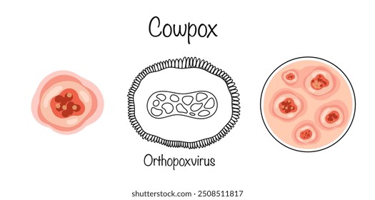 Doença infecciosa de natureza viral causada por um dos vírus do gênero Orthopoxvirus. O agente causador da varíola bovina e a manifestação da doença na pele. Ilustração vetorial.