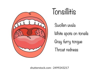 An infectious and inflammatory disease in which the palatine tonsils become inflamed. Drawn mouth of a person suffering from tonsillitis and the main symptoms of the disease. Vector illustration.