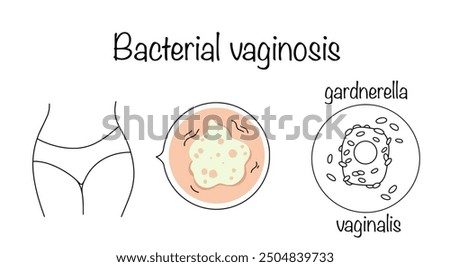 An infectious pathology in which the microflora in the vagina is disrupted. The causative agent of bacterial vaginosis and the manifestation of the disease in women. Vector illustration.