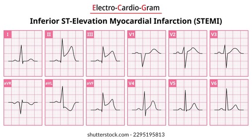 Inferior STEMI (ST-Elevation Myocardial Infarction) - The Differences in ECG Waveform for Each of the 12 Leads - Vectors and Illustrations for Medical Purposes