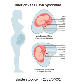 Inferior vena cava syndrome. Pregnant woman has a compression, invasion, or thrombosis of the IVC. Pregnancy problems. Vector flat illustration.