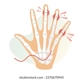Inflamation - Finger Joint Pain as Stock Illustration as EPS 10 File