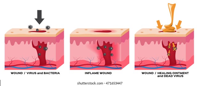 Inflame Wound , Healing Ointment Vector , Anatomy