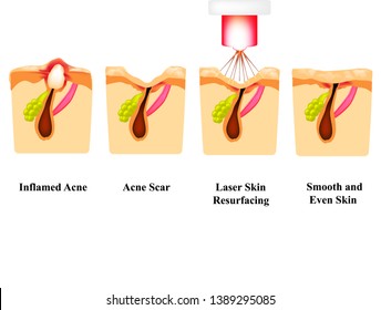 Inflamed acne on the skin. Inflamed pimple. Acne scar. Laser treatment. Laser polishing. The structure of the skin. Wrinkles. Infographics. Vector illustration on isolated background.