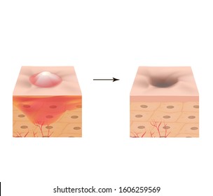 Inflamed acne on the skin. Inflamed pimple. The structure of the skin. Acne scar. Infographics. Vector illustration on isolated background.