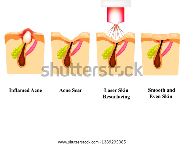 皮膚にきびの炎症 炎症を起こしたニキビ にきびの跡 レーザー治療 レーザー研磨 皮膚の構造 しわ インフォグラフィックス 分離型背景にベクターイラスト のベクター画像素材 ロイヤリティフリー