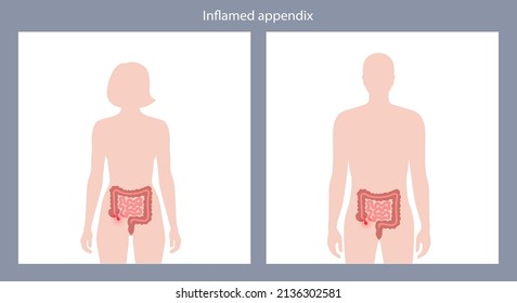Inflamed appendix in human body. Appendicitis and pain in intestine. Abdominal inflammation and belly ache concept. Internal organs medical poster flat vector illustration for clinic or education.