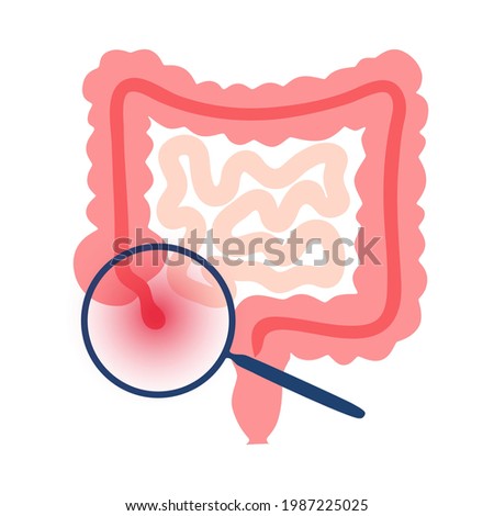 Inflamed appendix in human body. Appendicitis and pain in intestine. Abdominal inflammation and belly ache concept. Internal organs medical poster flat vector illustration for clinic or education.