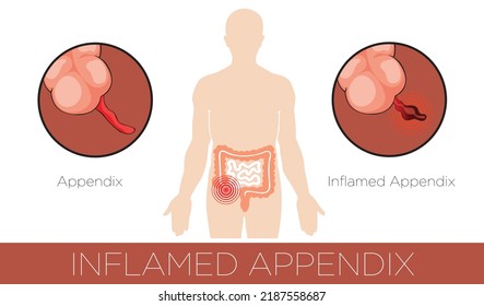 Inflamed Appendix Icon Vector Illustration.