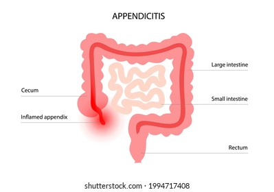 Inflamación en la infografía del apéndice. Apendicitis y dolor en el intestino. Inflamación abdominal, dolor de barriga en el cuerpo humano. Órganos internos carteles médicos ilustrativos de vectores planos para clínicas o educación.