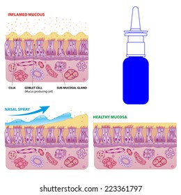 Inflamed and normal nasal mucosa cells and micro cilia vector scheme with nasal spray effect and bottle