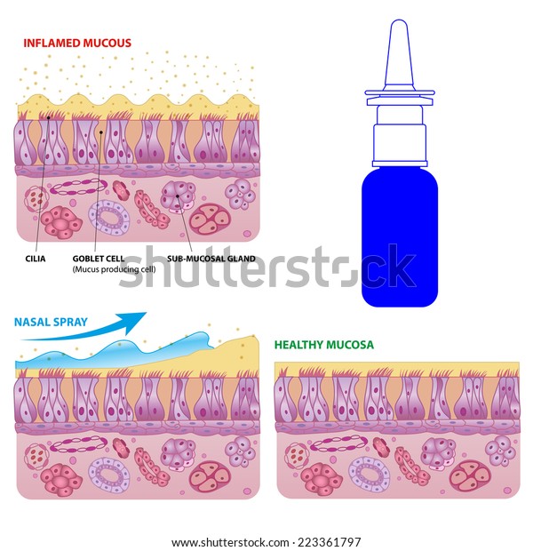 Inflamed and normal nasal\
mucosa cells and micro cilia vector scheme with nasal spray effect\
and bottle