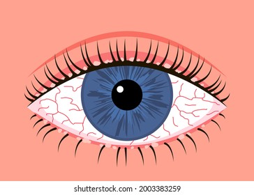 Inflamed sick human eye with blepharitis, allergy symptom red veins. Eye disease, fatigue or allergic conjunctivitis infection. Vector illustration