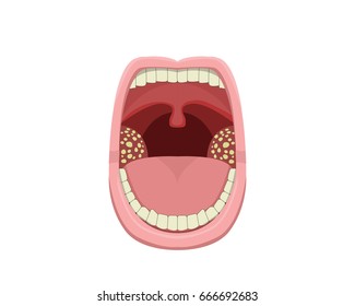 Inflamed Tonsillitis in vector design