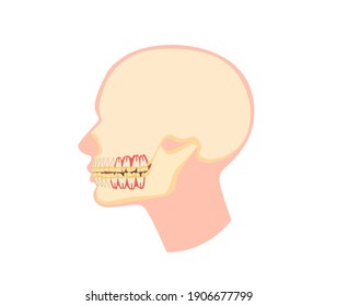 Inflamed tooth gums illustration. Human head with red infectious paradanthosis caries decay of tooth enamel and purulent vector abscesses.