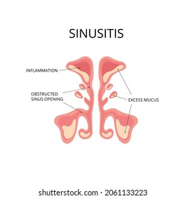 Inflammated sinus with excess mucus and obstrusted sinus openings. Infection, nasal disease, anatomy. Can be used for topics like diagnosis, congestion, flu