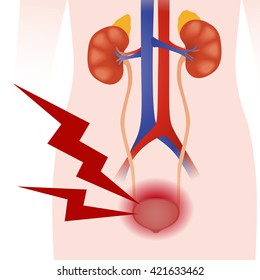 Inflammation Of The Bladder, Human Urinary Organs, Heart, Kidney, Bladder, Vector Illustration