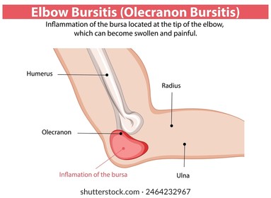 Inflammation of the elbow bursa causing pain