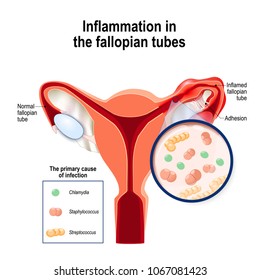 Inflammation in the fallopian tubes. A major cause of female infertility. Uterus and uterine tubes. Human anatomy. female reproductive system. Close-up of the primary cause of infection