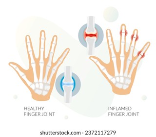 Inflammation - Finger Joint Pain as Stock Illustration as EPS 10 File