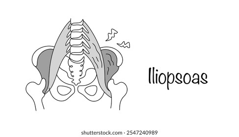 Inflamación del músculo iliopsoas, que se encuentra entre la parte frontal del muslo y la parte interna de la articulación de la cadera. Dibujo de una pelvis humana con signos de ilepsitis. Ilustración vectorial.