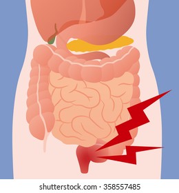 inflammation of the intestine and human digestive organs, vector illustration