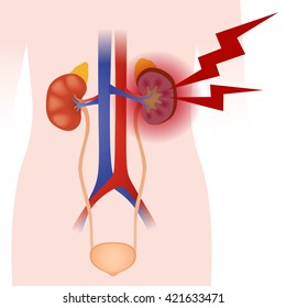 Inflammation Of The Kidney, Human Urinary Organs, Heart, Kidney, Bladder, Vector Illustration