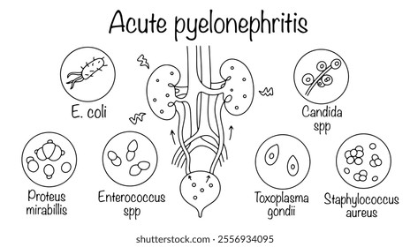 Inflammation in the kidneys, which occurs due to an infection that rises from the bladder to the kidneys. Drawn human urinary system and the main causative agents of acute pyelonephritis.