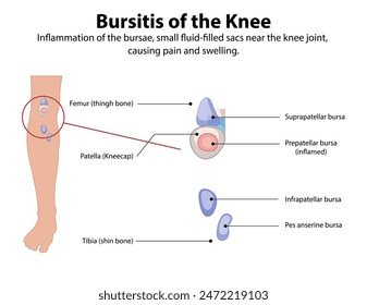 Inflammation of knee bursae causing pain and swelling