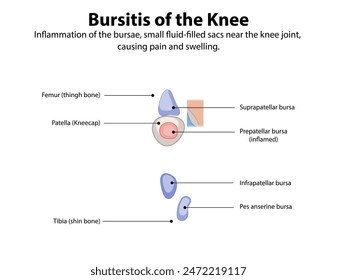 Inflammation of knee bursae causing pain and swelling