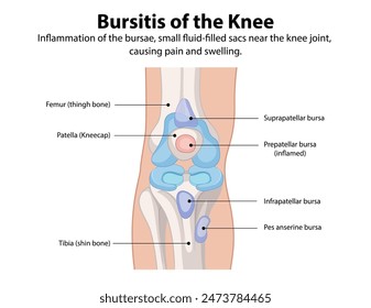 Inflammation of knee bursae causing pain and swelling