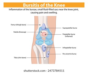 Inflammation of knee bursae causing pain and swelling