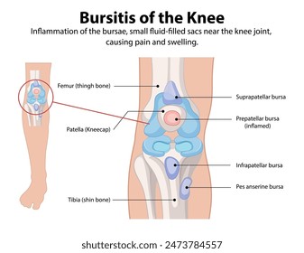 Inflammation of knee bursae causing pain and swelling