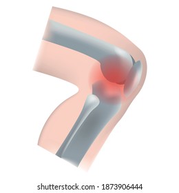 Inflamación de la articulación de la rodilla. El aspecto de los huesos de un lado. Fibula, tibia, radio. Ilustración vectorial.