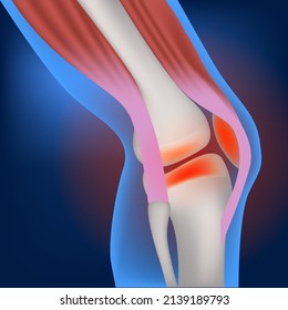 Inflammation of the knee joint and miniscus. Disease of the musculoskeletal system. vector illustration