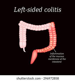 Inflammation of the large intestine divisions. Vector illustration on a black background.