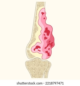 inflammation leg bone with tumor cell the Ewing's sarcoma hip femur gross pain and soft tissues gene mutation chromosomal of chondrosarcoma by needle transplant