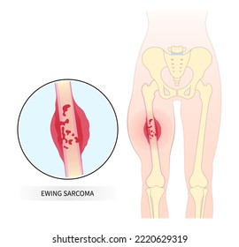 inflammation leg bone with tumor cell the Ewing's sarcoma hip femur gross pain and soft tissues gene mutation chromosomal of chondrosarcoma by needle transplant